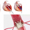 近50%的60岁以下患者选择TAVR而不是手术主动脉瓣置换术但结果较差